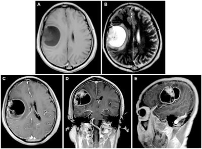 A case report: Gliosarcoma associated with a germline heterozygous mutation in MSH2